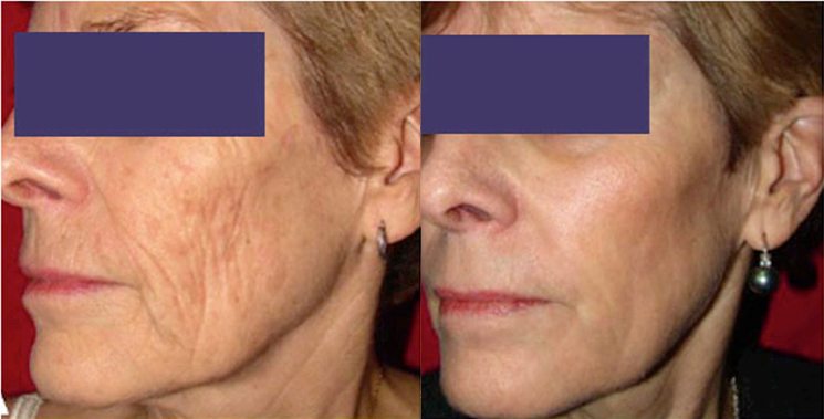 Laser Skin Resurfacing